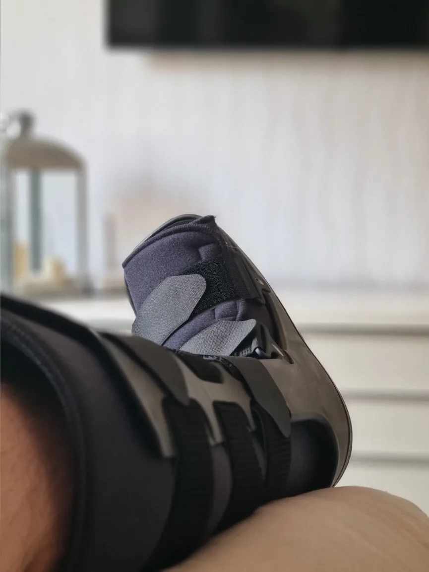 Walking again ten weeks after beach ankle sprain